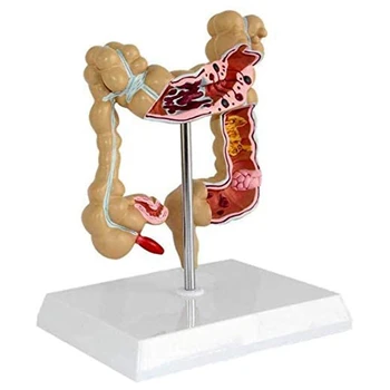 Модел болестно колоректален рак на дебелото черво Модел на Стомашно-чревния тракт Анатомическая Модел